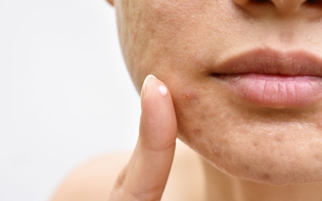 Pelle a tendenza acneica si può guarire